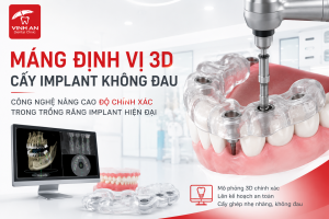 Máng Định Vị 3D Cấy Implant Không Đau