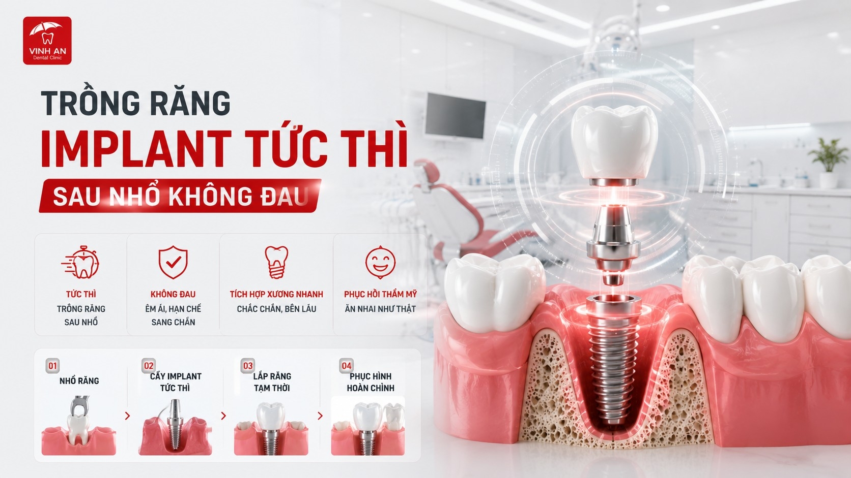 Trồng Răng Implant Tức Thì Sau Nhổ Không Đau