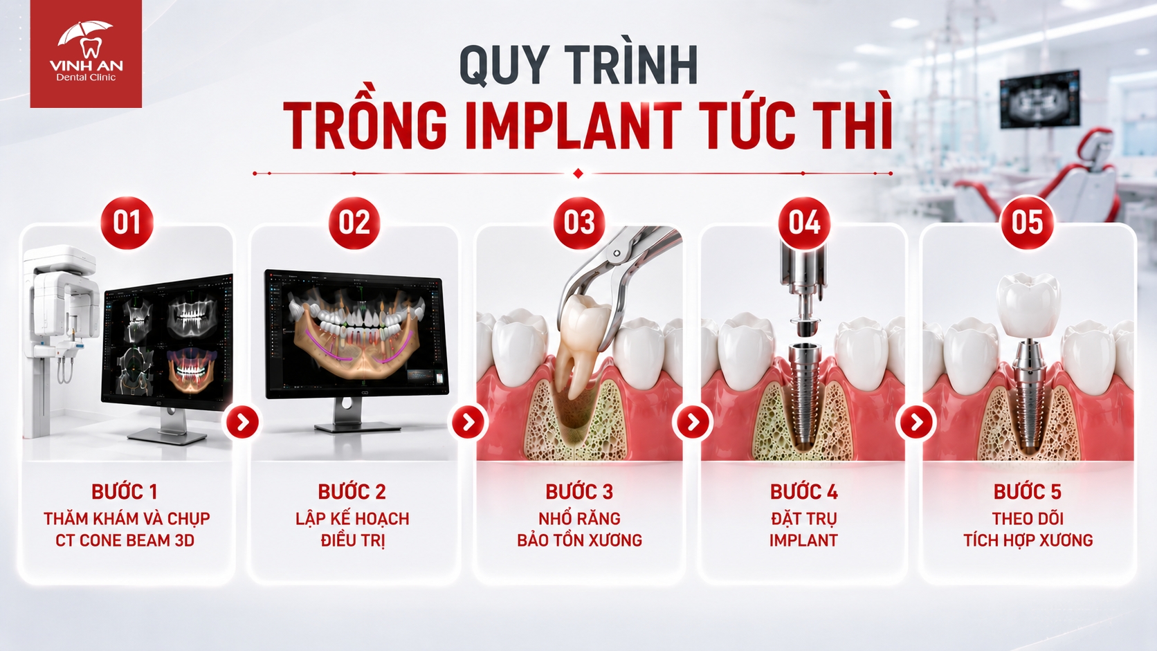 Quy Trình Trồng Implant Tức Thì