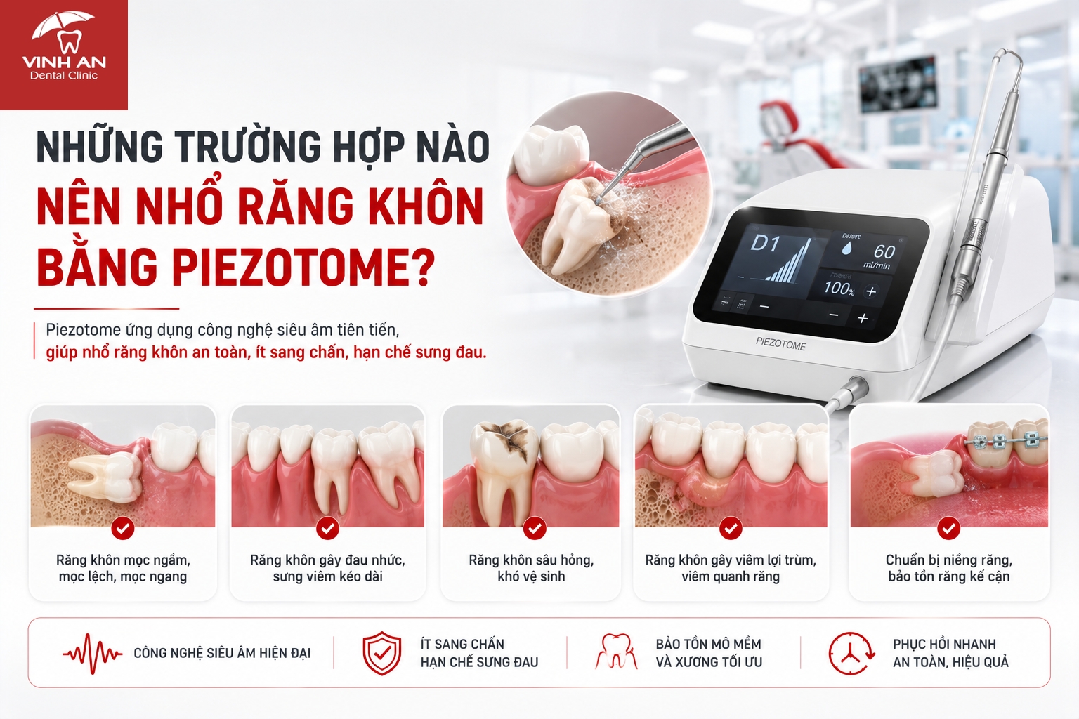 Những Trường Hợp Nào Nên Nhổ Răng Khôn Bằng Piezotome?