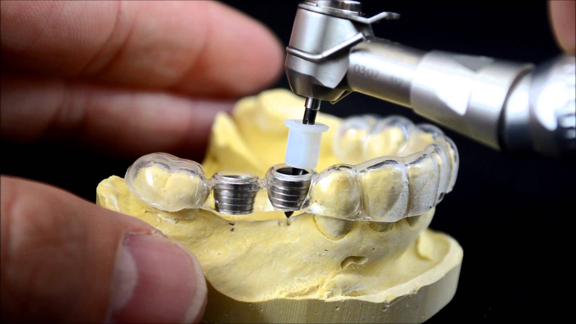 Máng Định Vị Implant 3D