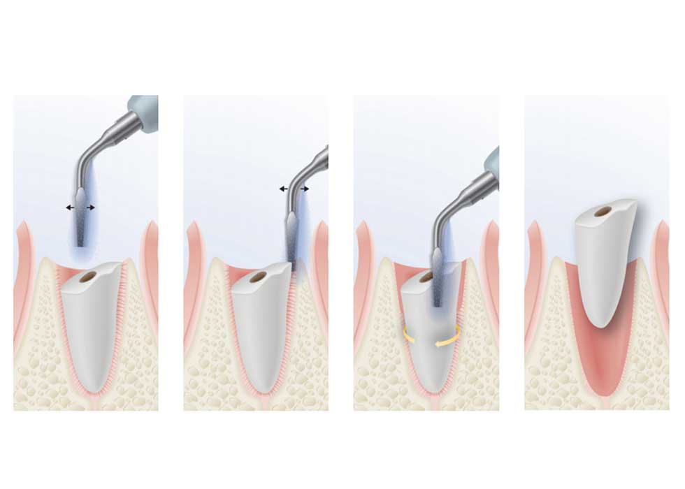 Máy Piezotome Được Đánh Giá Cao Trong Nhổ Răng Khôn