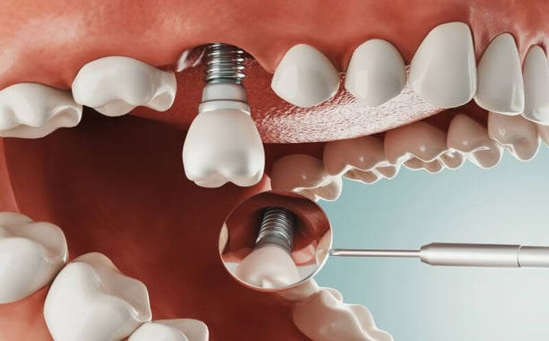 Implant Tức Thì
