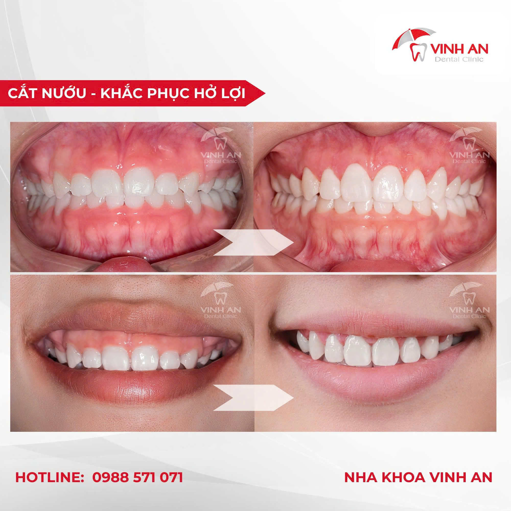 Tạo Hình Nướu Thẩm Mỹ Bằng Laser