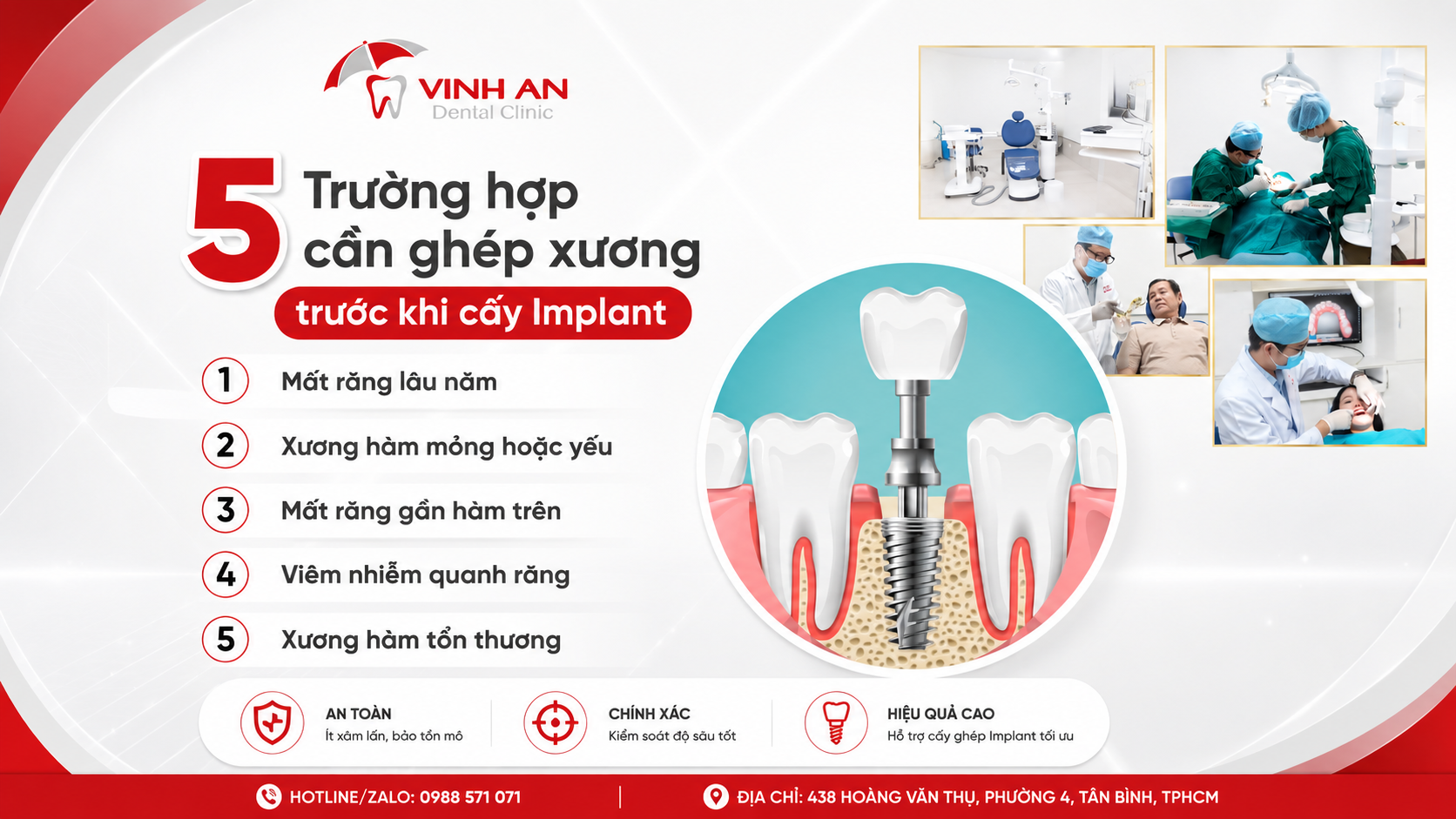 Trường Hợp Cần Ghép Xương Khi Implant