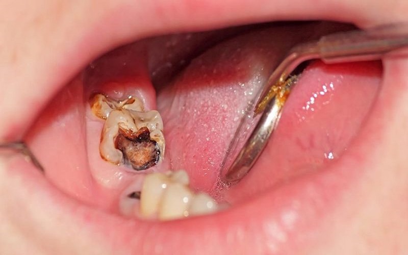 Điều Trị Sâu Răng