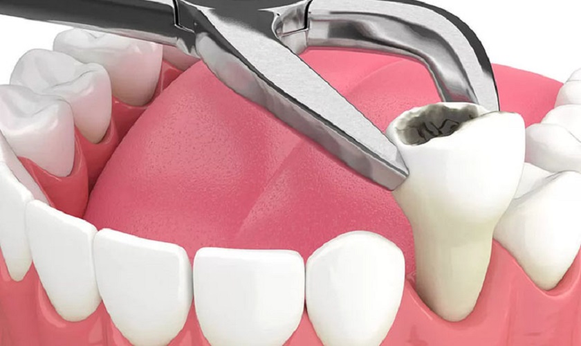 Có Phải Niềng Răng Luôn Cần Nhổ Răng?