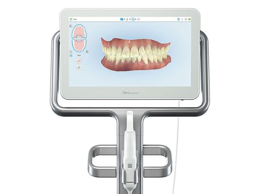 Hình ảnh scan dấu răng kỹ thuật số.