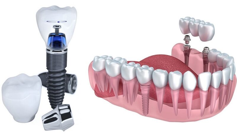 Những Ai Nên Trồng Implant?
