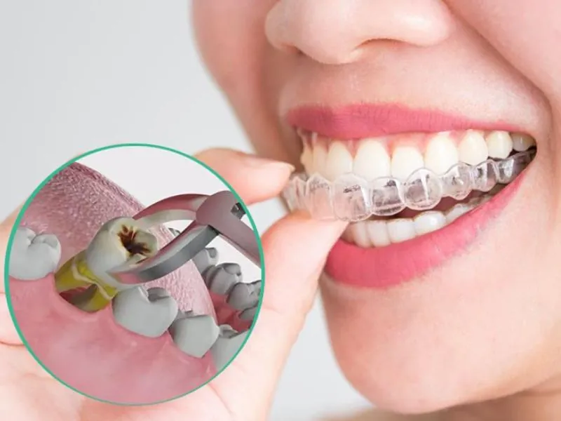 Chỉnh Nha Không Nhổ Răng Có Hiệu Quả Không?