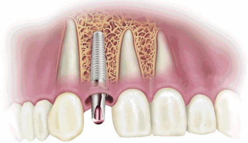 Giai Đoạn Tích Hợp Xương