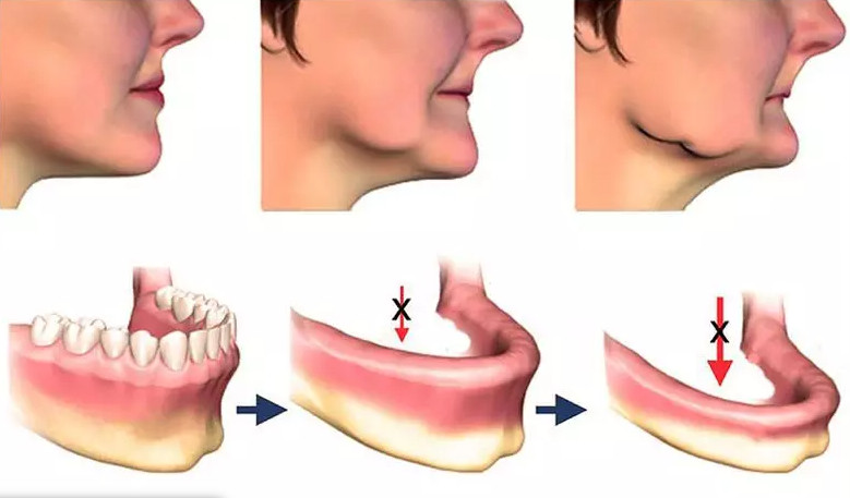 Hạn Chế Tiêu Xương Hàm