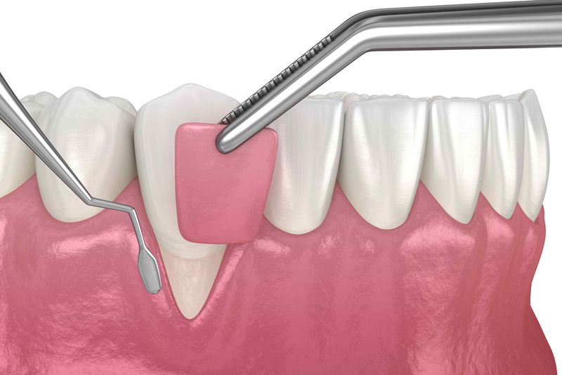 Crown Lengthening