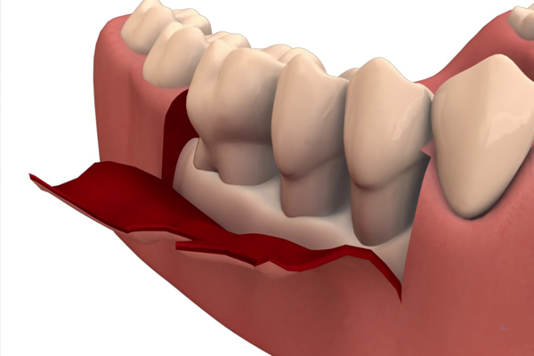 Gum Flap Surgery (Pocket Reduction Surgery)