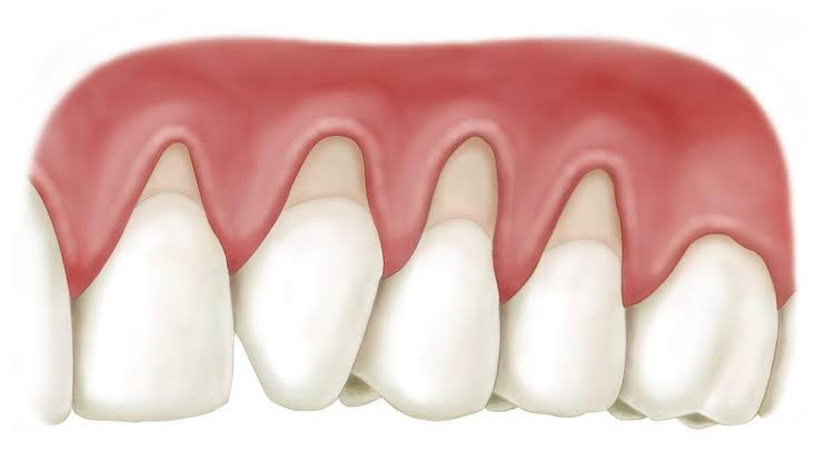 Gum Recession