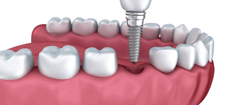 Can a Periodontist Place Dental Implants?