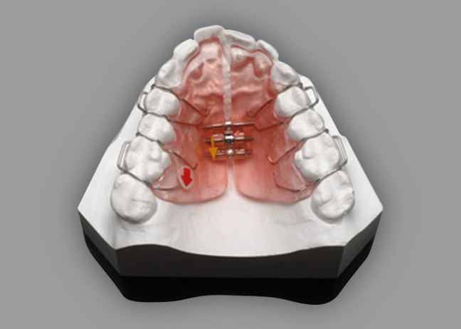 làm răng giả bằng Implant uy tín