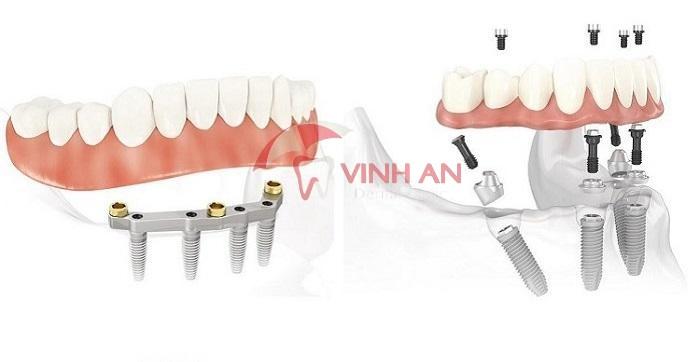 Trồng răng implant giá tốt nhất TPHCM 2020