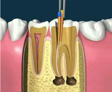 Phương pháp làm răng giả