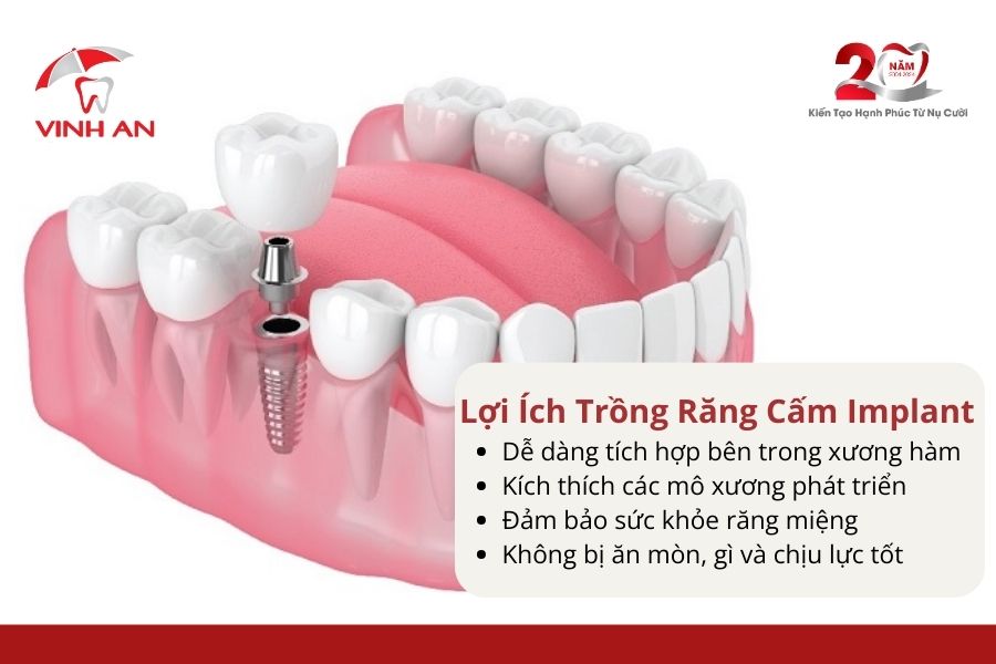 Giatrongrangcamimplant2