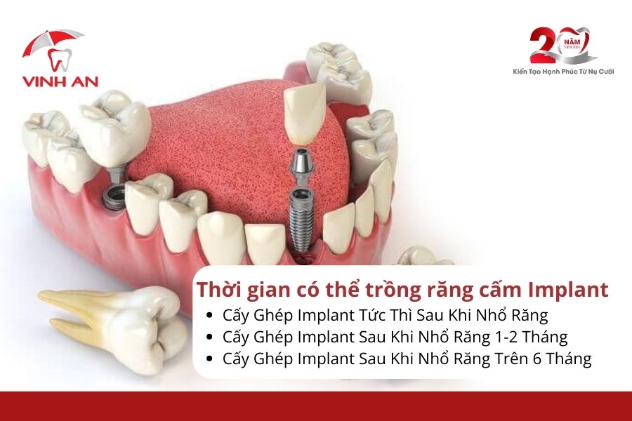 Giatrongrangcamimplant5