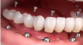 quy trình làm răng sứ thẩm mỹ