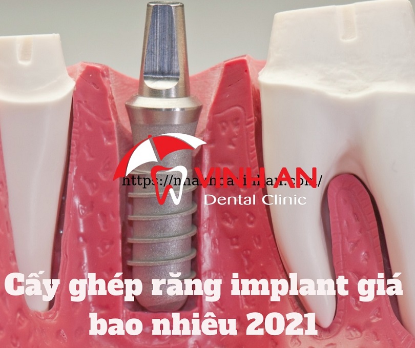 Cấy ghép răng implant mất bao nhiêu tiền 2021