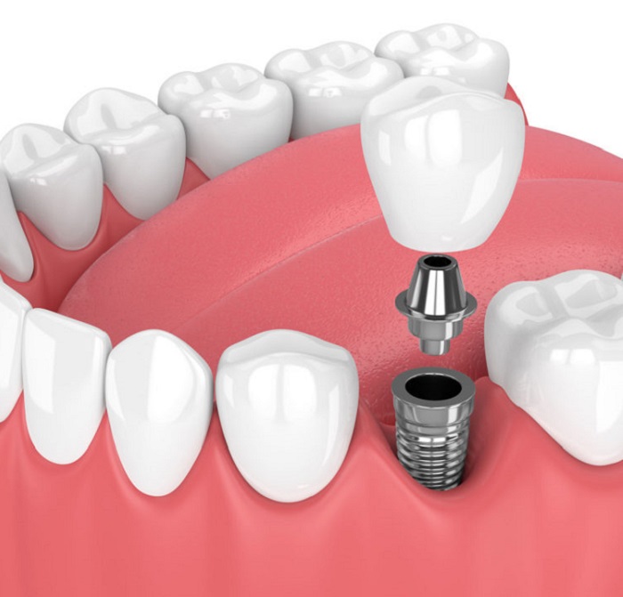 cấy ghép implant khi mất nhiều răng gần nhau, nguồn: https://roanokeoralsurgery.com/services/dental-implants/dental-implant-procedure/