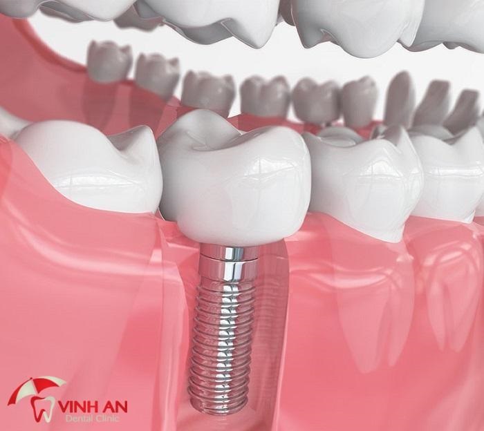 Mất răng số 6, mất răng hàm lâu năm có thể cấy ghép implant