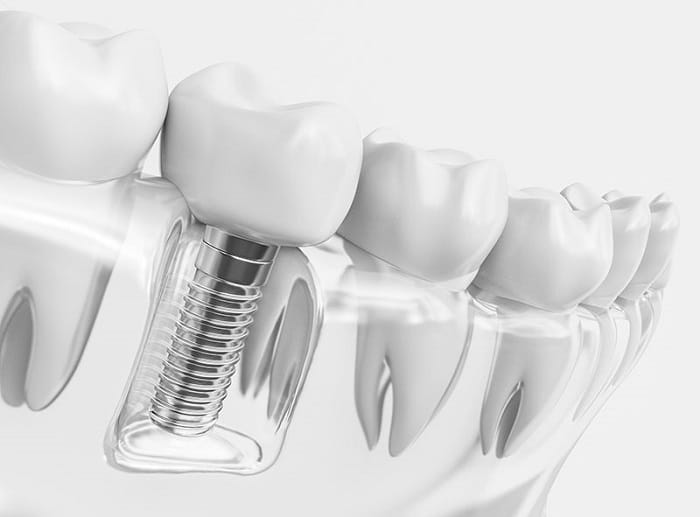 Dental implants Implants and crowns have advantages