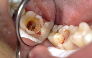 Răng Sâu Nặng - Những Phương Pháp Điều Trị Triệt Để