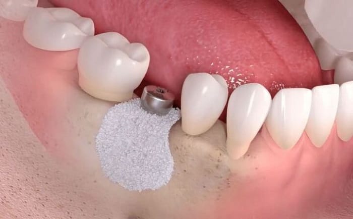 Phẫu thuật ghép xương trong trồng Implant thực hiện thế nào