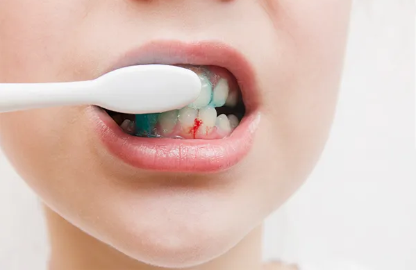 Nguyên nhân chat máu chân răng do đâu?
