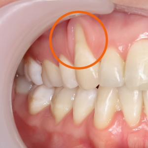 Nguyên Nhân Gây Tụt Lợi Và Cách Chữa Trị Hiệu Quả 