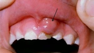 SƯng chân răng do nhiễm trùng
