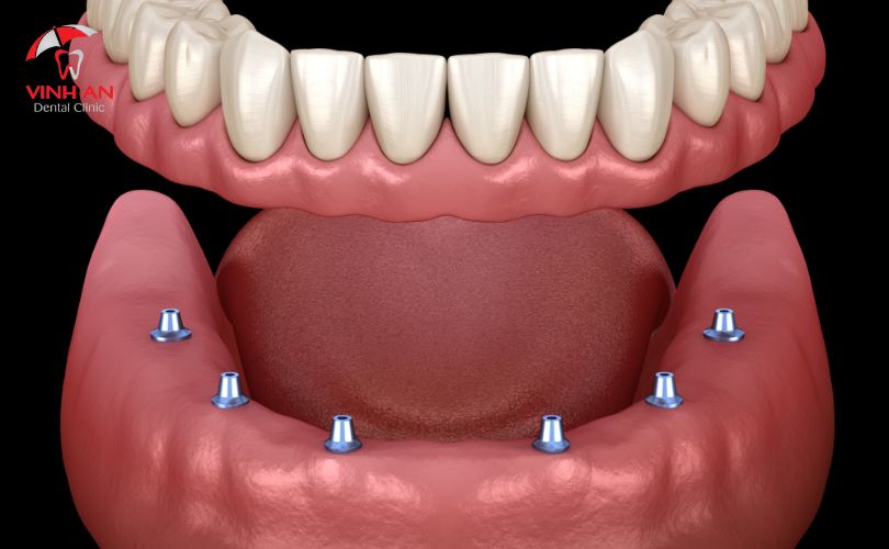 Răng Giả Tháo Lắp Trên Trụ Cấy Implant
