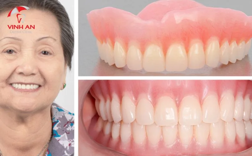 Răng giả tháo lắp loại nào tốt?