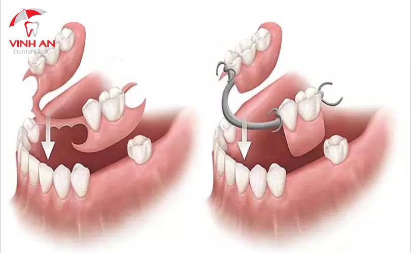 Răng giả tháo lắp loại nào tốt?