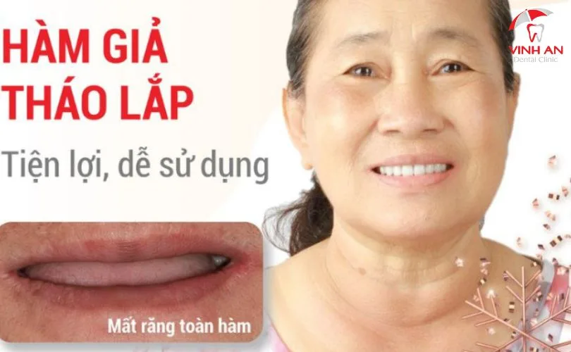Răng giả tháo lắp loại nào tốt?