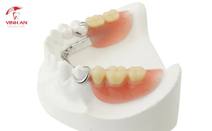 Răng giả tháo lắp loại nào tốt?