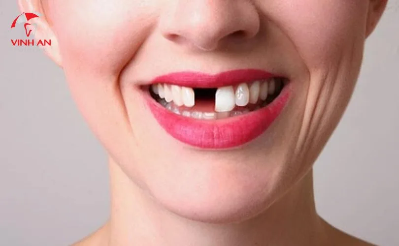Răng giả tháo lắp loại nào tốt