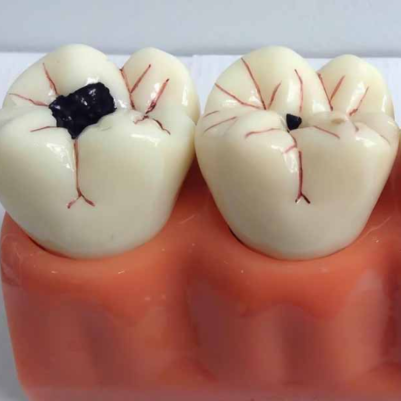 Hậu quả của chứng hôi miệng do sâu răng