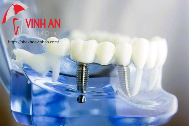 Trồng răng implant có niềng được răng không?