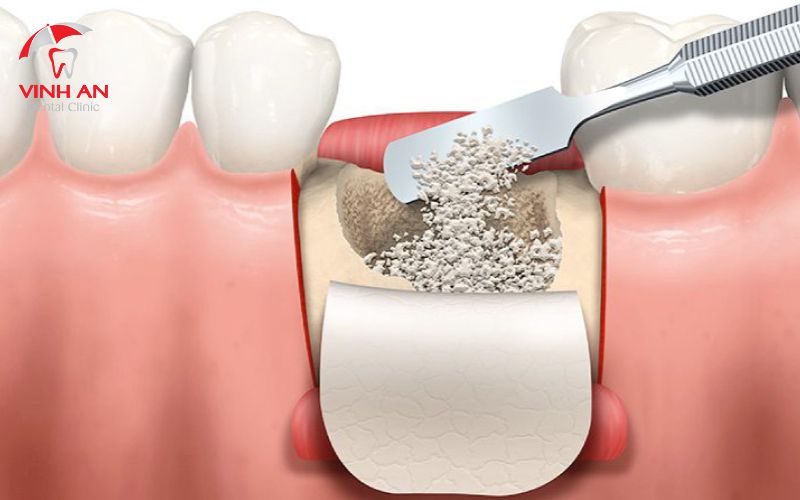 Phẫu thuật ghép xương răng trong trồng răng Implant