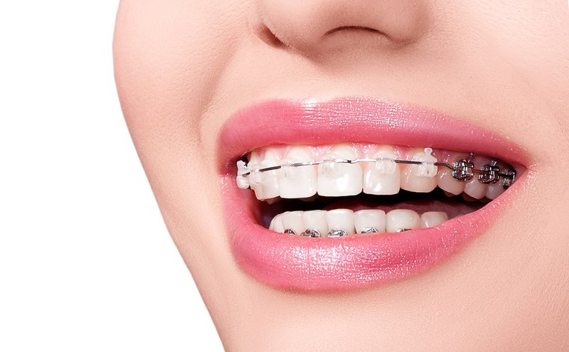 Niềng răng là phương pháp làm đẹp phổ biến ở nha khoa