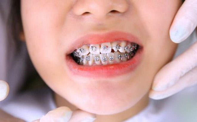 Niềng răng sai cách dẫn đến một số biến chứng