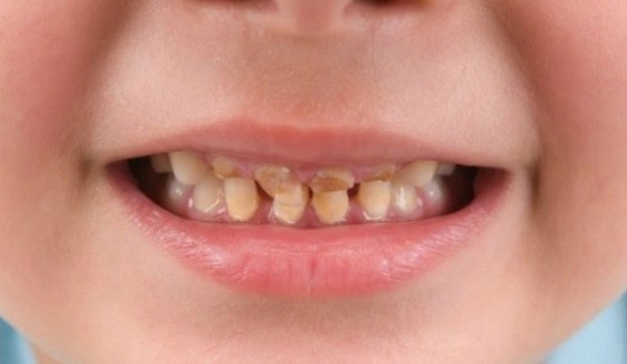 Bệnh ăn mòn men răng ở trẻ em