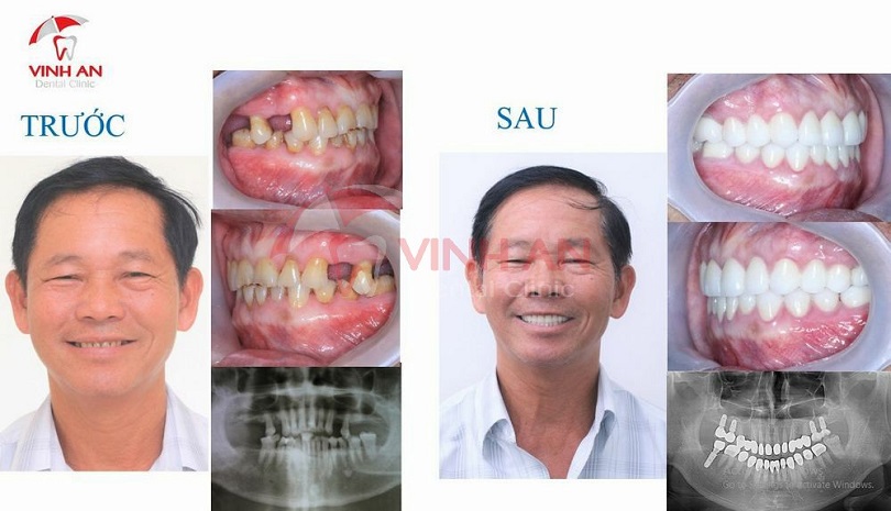 Trồng răng implant giá rẻ cẩn thận những hiểm họa khôn lường
