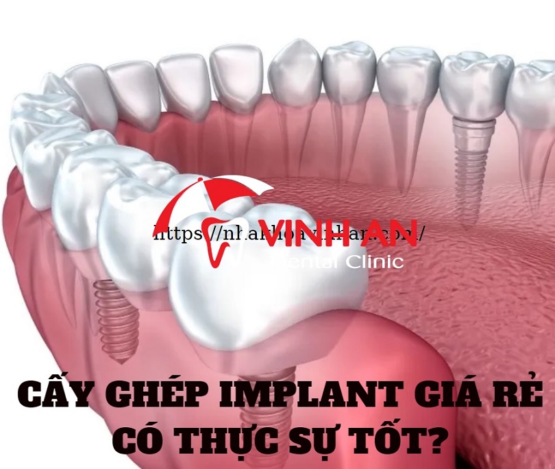Sự khác nhau giữa trồng răng implant giá rẻ và implant cao cấp?