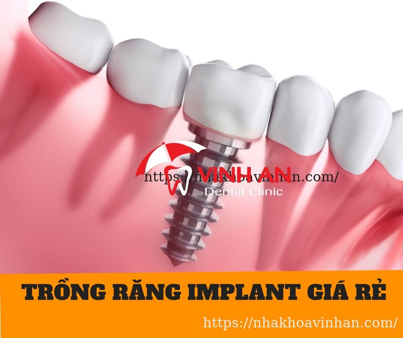 Vì sao có trường hợp trồng răng implant giá rẻ hơn mặt bằng chung?